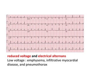 reduced voltage  and  electrical alternans Low voltage : emphysema, infiltrative myocardial disease, and pneumothorax  