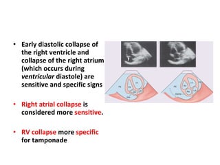 Early diastolic collapse of the right ventricle and collapse of the right atrium (which occurs during  ventricular  diastole) are sensitive and specific signs Right atrial collapse  is considered more  sensitive . RV collapse  more  specific  for tamponade 
