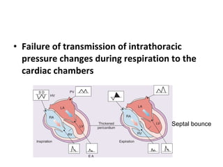 Failure of transmission of intrathoracic pressure changes during respiration to the cardiac chambers  Septal bounce 
