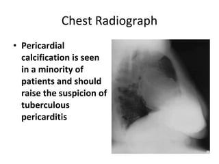 Chest Radiograph Pericardial calcification is seen in a minority of patients and should raise the suspicion of tuberculous pericarditis  