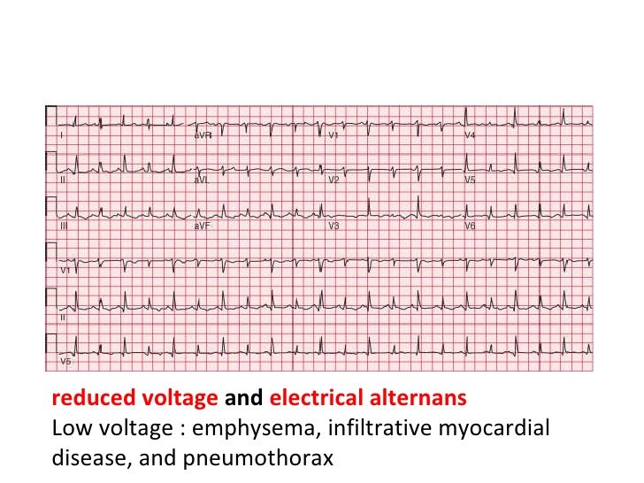 Pericardial Disease