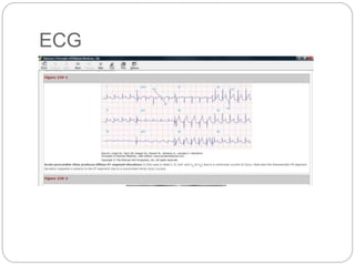 ECG
 