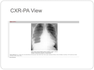 CXR-PA View
 