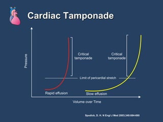 Cardiac Tamponade Spodick, D. H. N Engl J Med 2003;349:684-690 