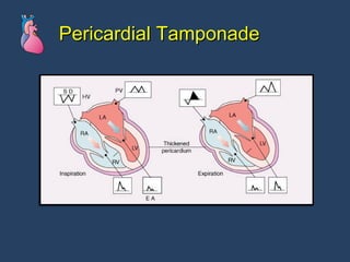 Pericardial Tamponade 