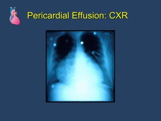 Pericardial Effusion: CXR 