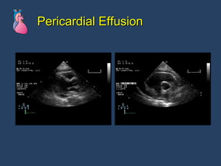 Pericardial Effusion 