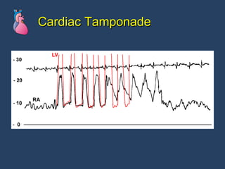 Cardiac Tamponade 