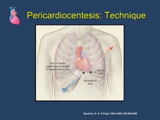 Pericardiocentesis: Technique Spodick, D. H. N Engl J Med 2003;349:684-690 