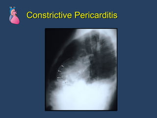 Constrictive Pericarditis 