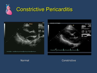 Constrictive Pericarditis Normal Constrictive 