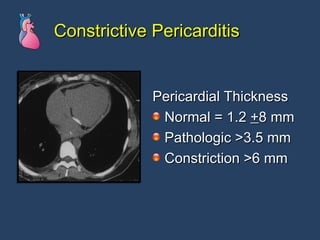Constrictive Pericarditis Pericardial Thickness Normal = 1.2  + 8 mm Pathologic >3.5 mm Constriction >6 mm 