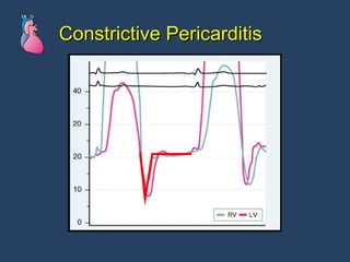 Constrictive Pericarditis 