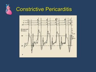 Constrictive Pericarditis 