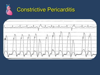 Constrictive Pericarditis 