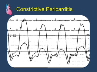 Constrictive Pericarditis 