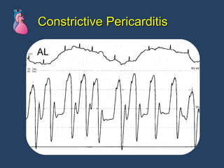 Constrictive Pericarditis 