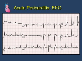 Acute Pericarditis: EKG 