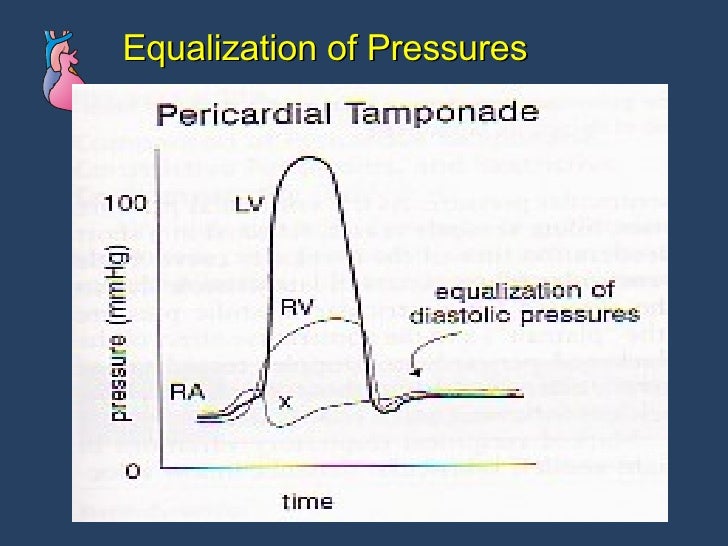Pericardial Dse Cath Lab