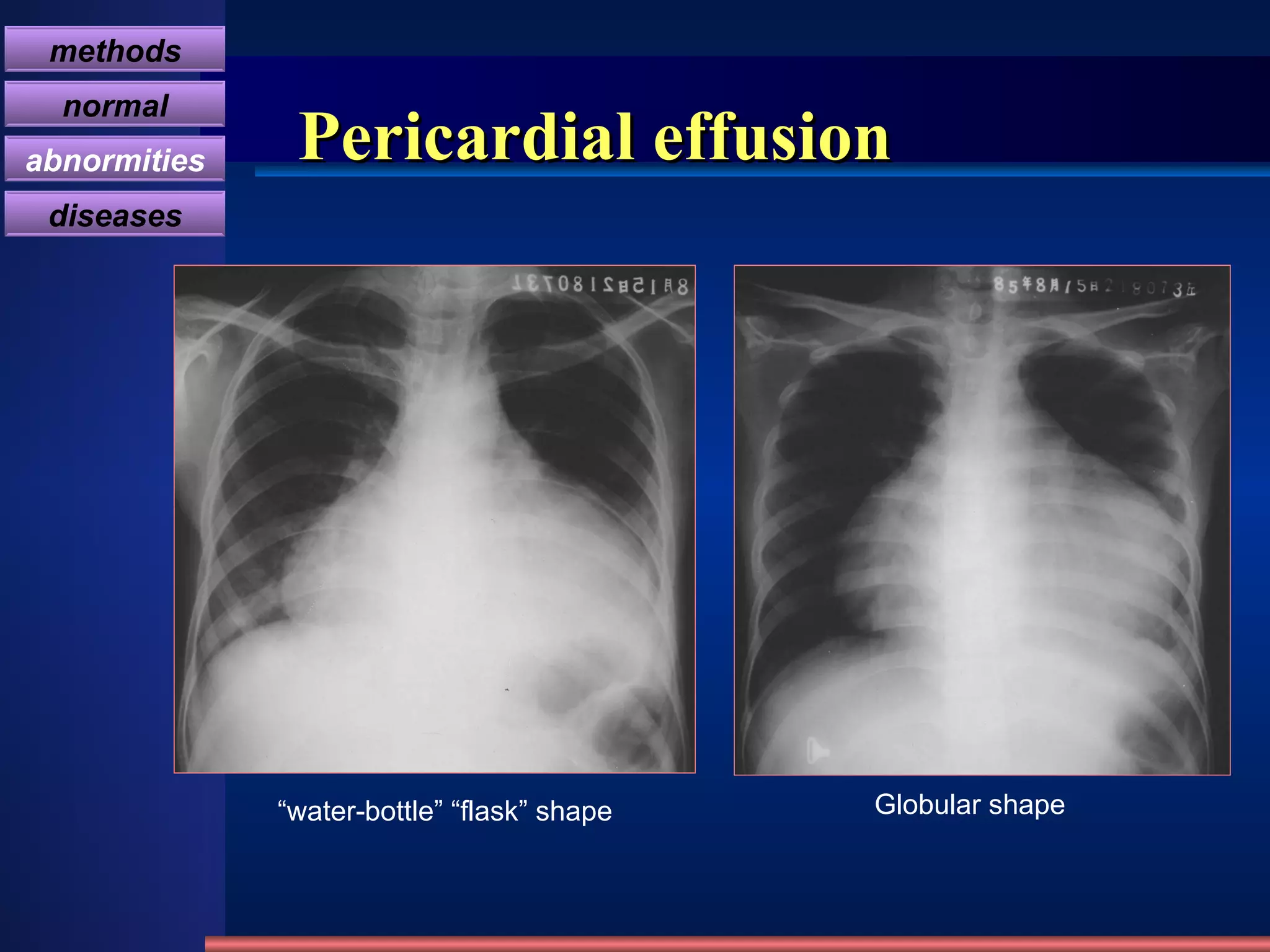 Pericardial effusion “ water-bottle” “flask” shape Globular shape methods normal abnormities diseases 