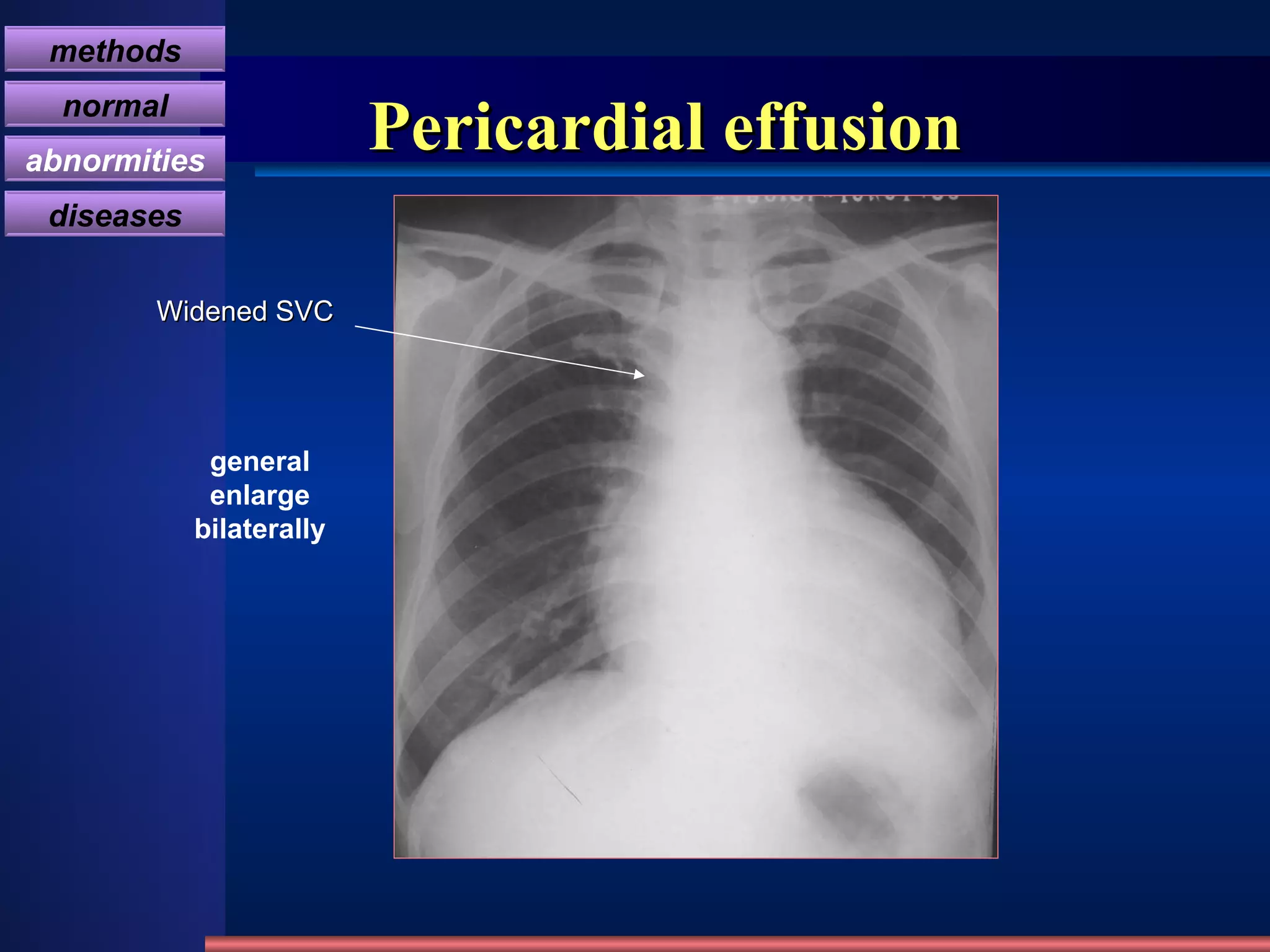 Pericardial effusion general enlarge bilaterally Widened SVC methods normal abnormities diseases 