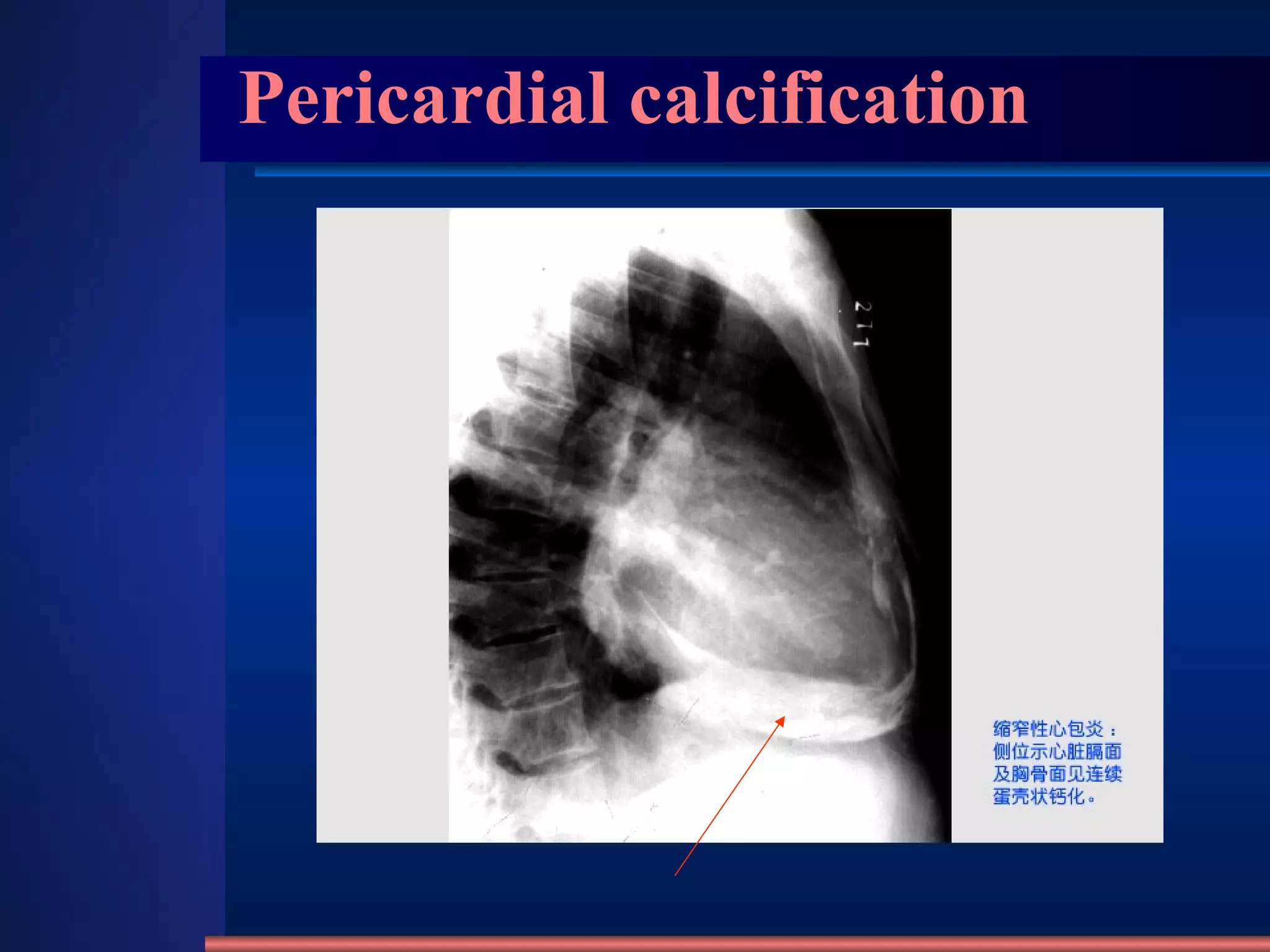 Pericardial calcification 