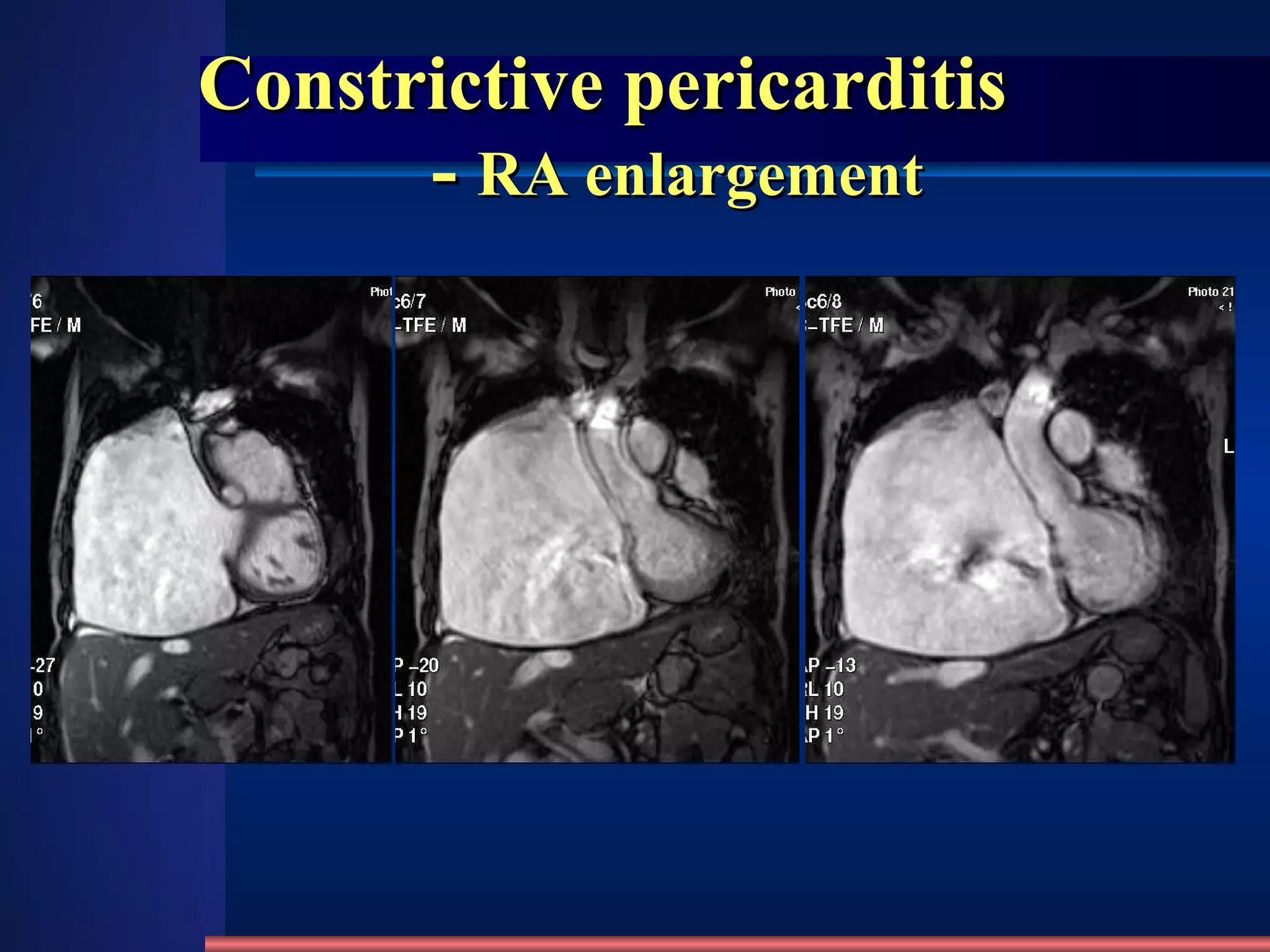 Constrictive pericarditis   -  RA enlargement 