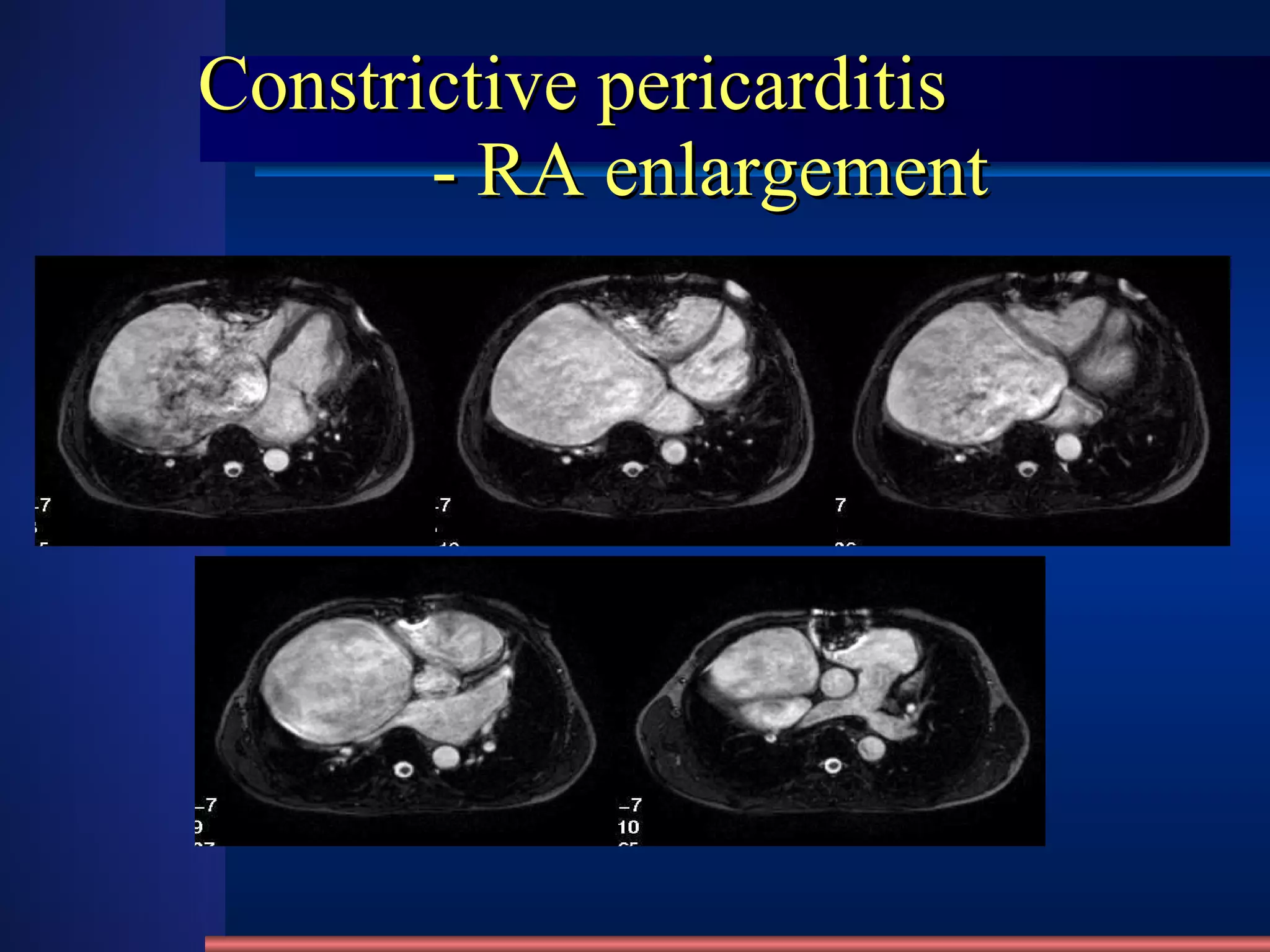 Constrictive pericarditis   - RA enlargement 