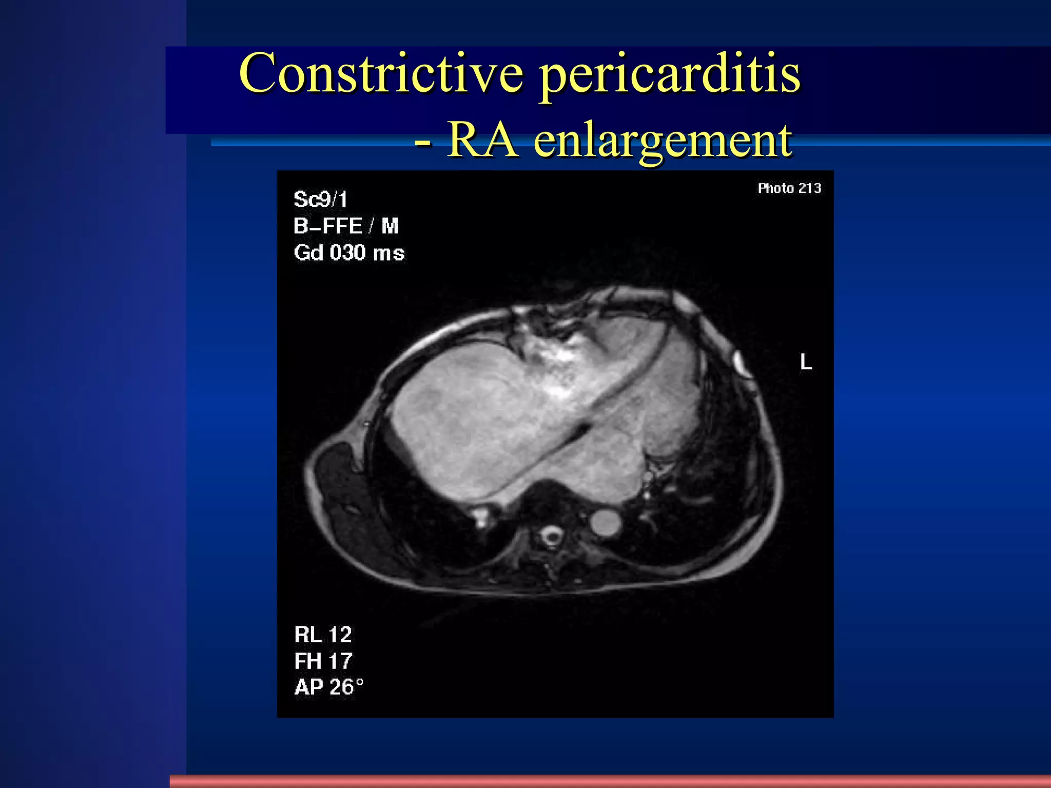 Constrictive pericarditis   -  RA enlargement 
