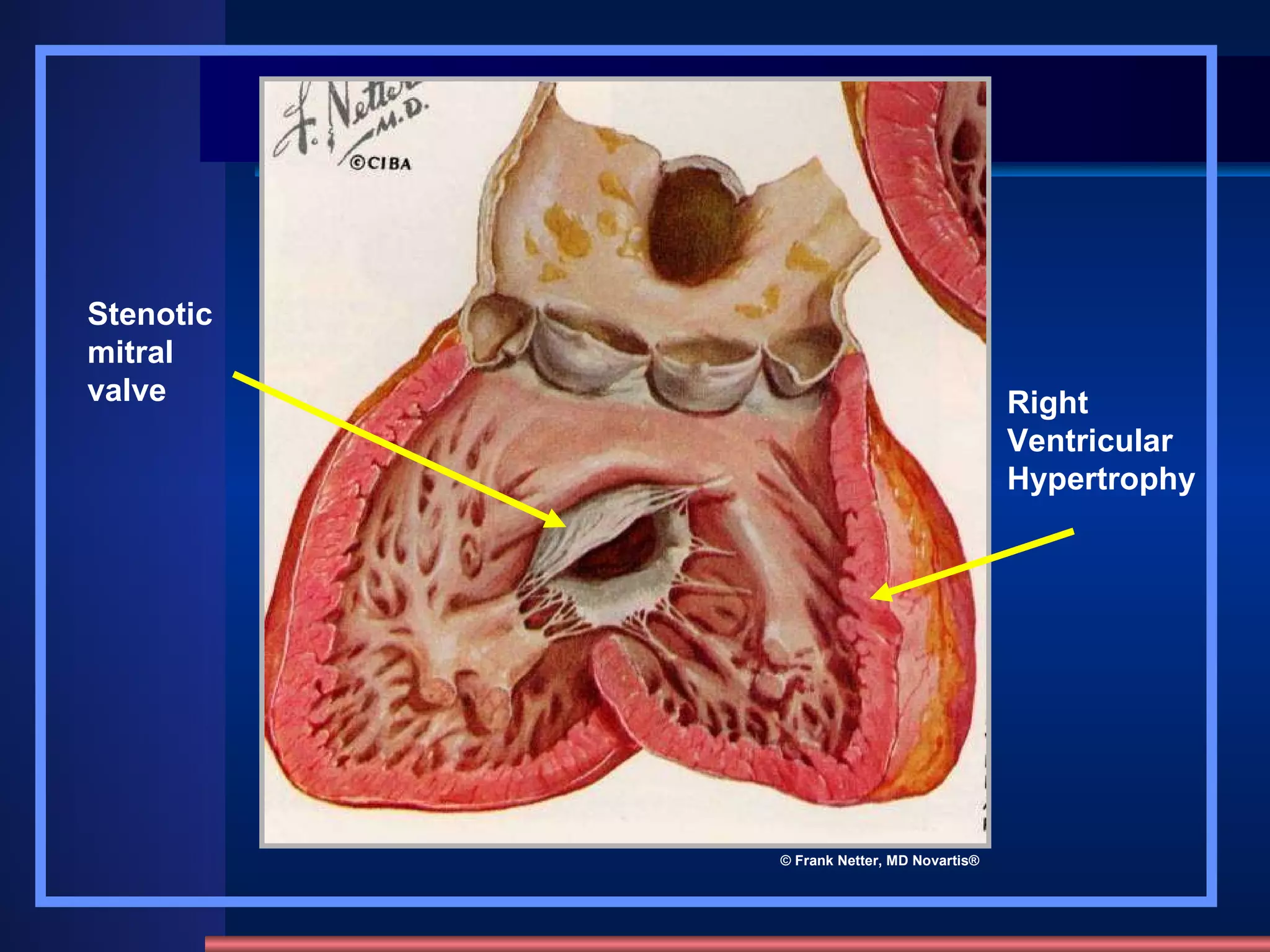 Right Ventricular Hypertrophy Stenotic mitral valve © Frank Netter, MD Novartis® 