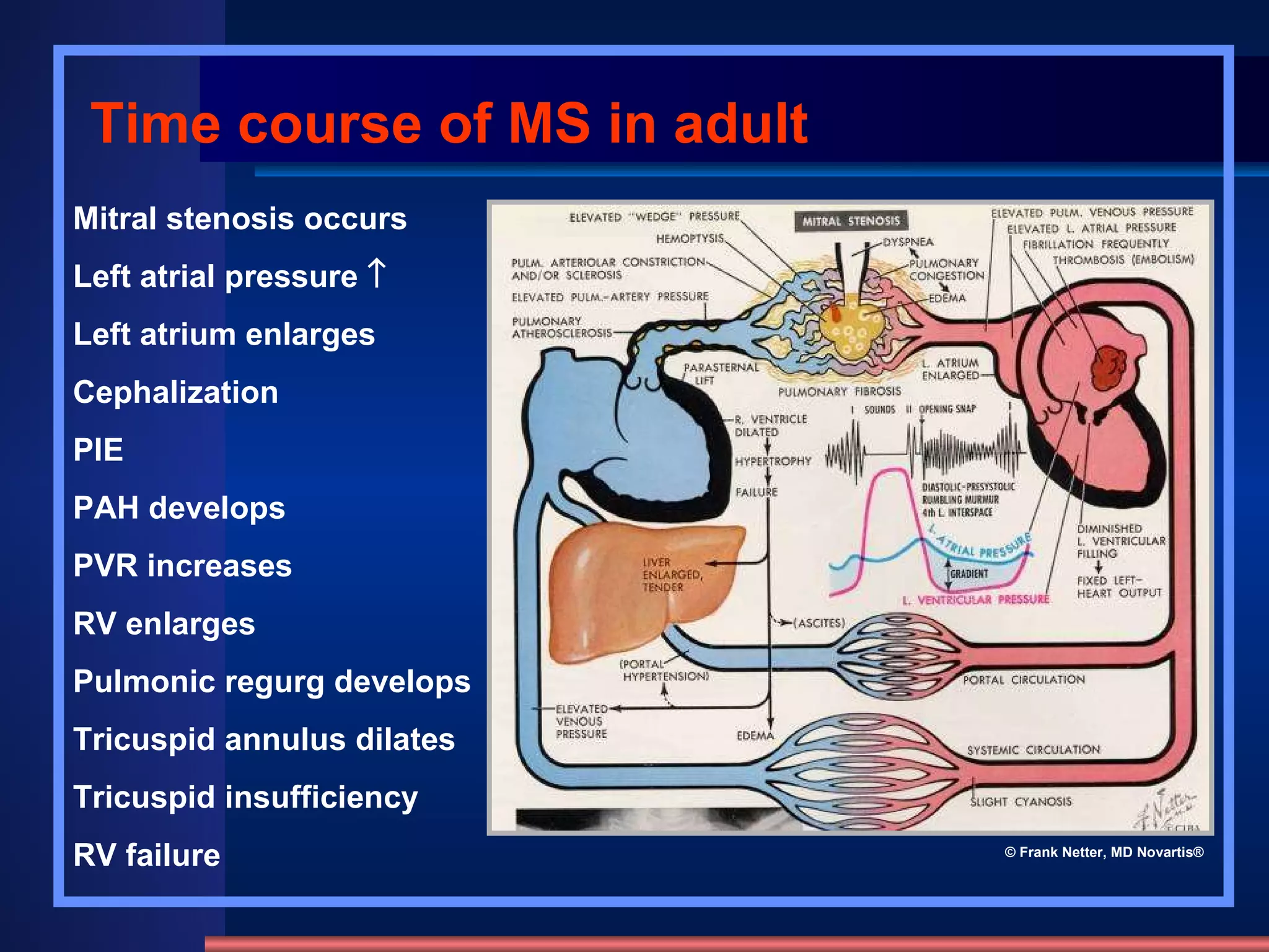 Mitral stenosis occurs  Left atrial pressure     Left atrium enlarges  Cephalization  PIE  PAH develops  PVR increases  RV enlarges  Pulmonic regurg develops  Tricuspid annulus dilates  Tricuspid insufficiency  RV failure Time course of MS in adult © Frank Netter, MD Novartis® 