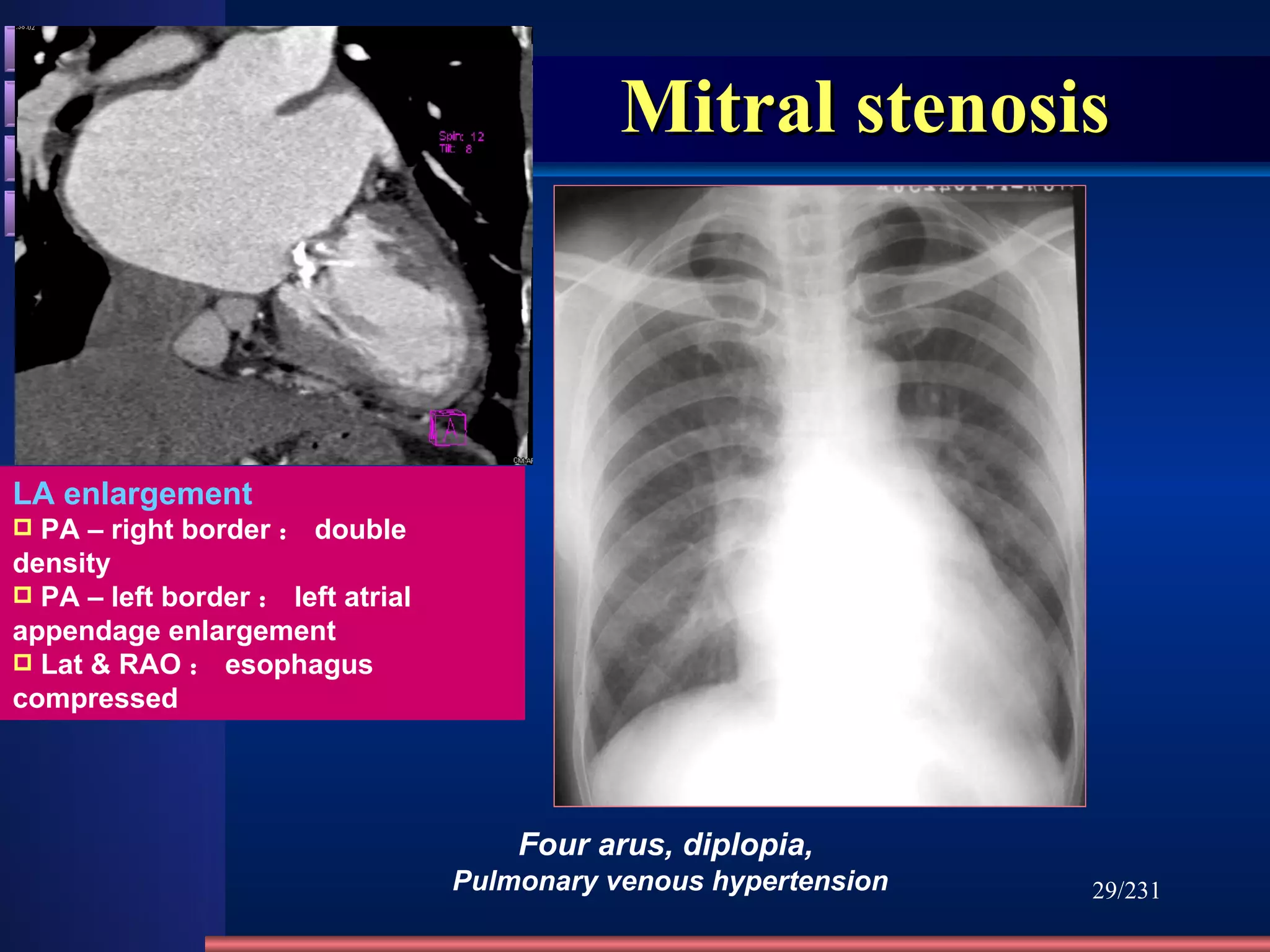 Mitral stenosis /231 Four arus, diplopia,  Pulmonary venous hypertension LA enlargement PA – right border ： double density PA – left border ： left atrial appendage enlargement Lat & RAO ： esophagus compressed methods normal abnormities diseases 