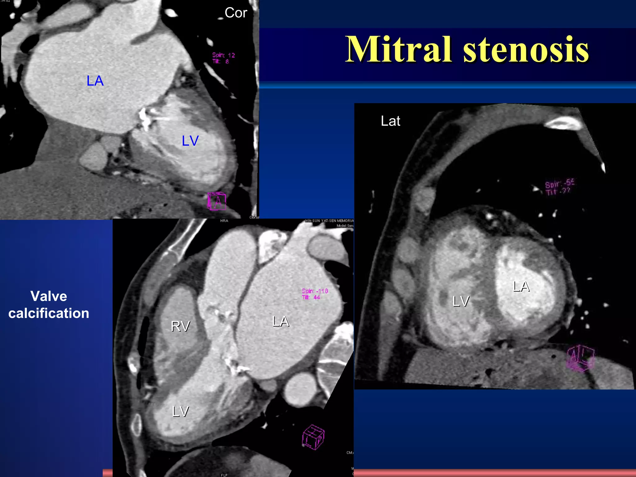 Mitral stenosis LA LV RV LA LV LV LA Valve calcification Lat Cor  
