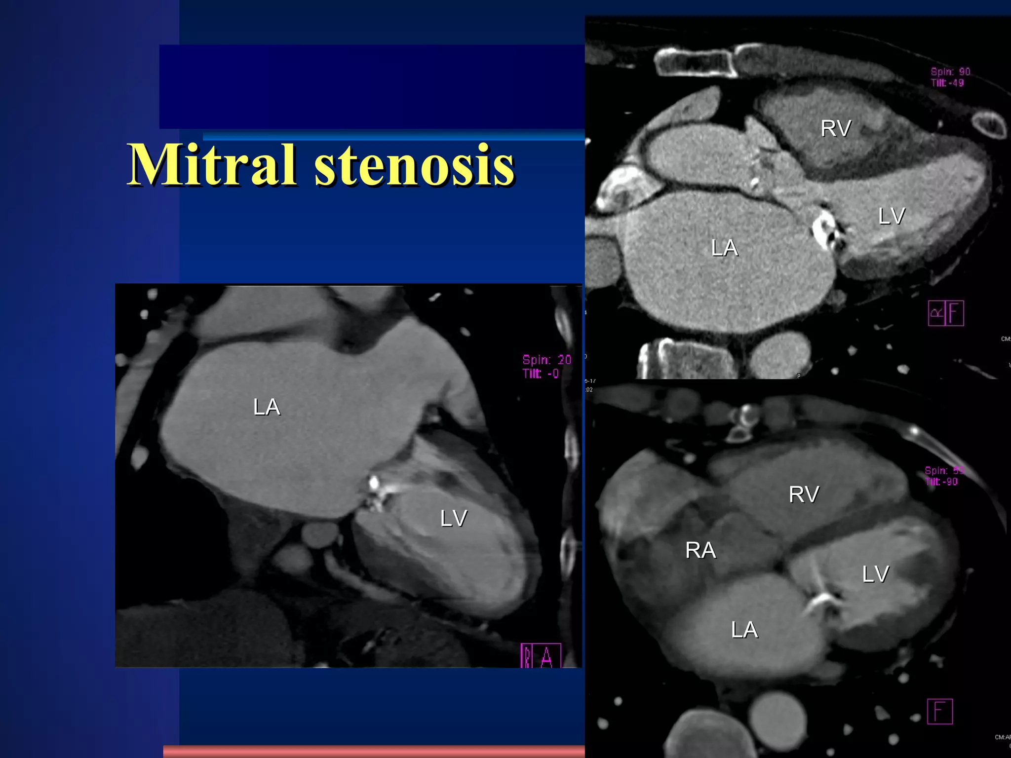 Mitral stenosis LA LV LA LV LA RV LV RA RV 