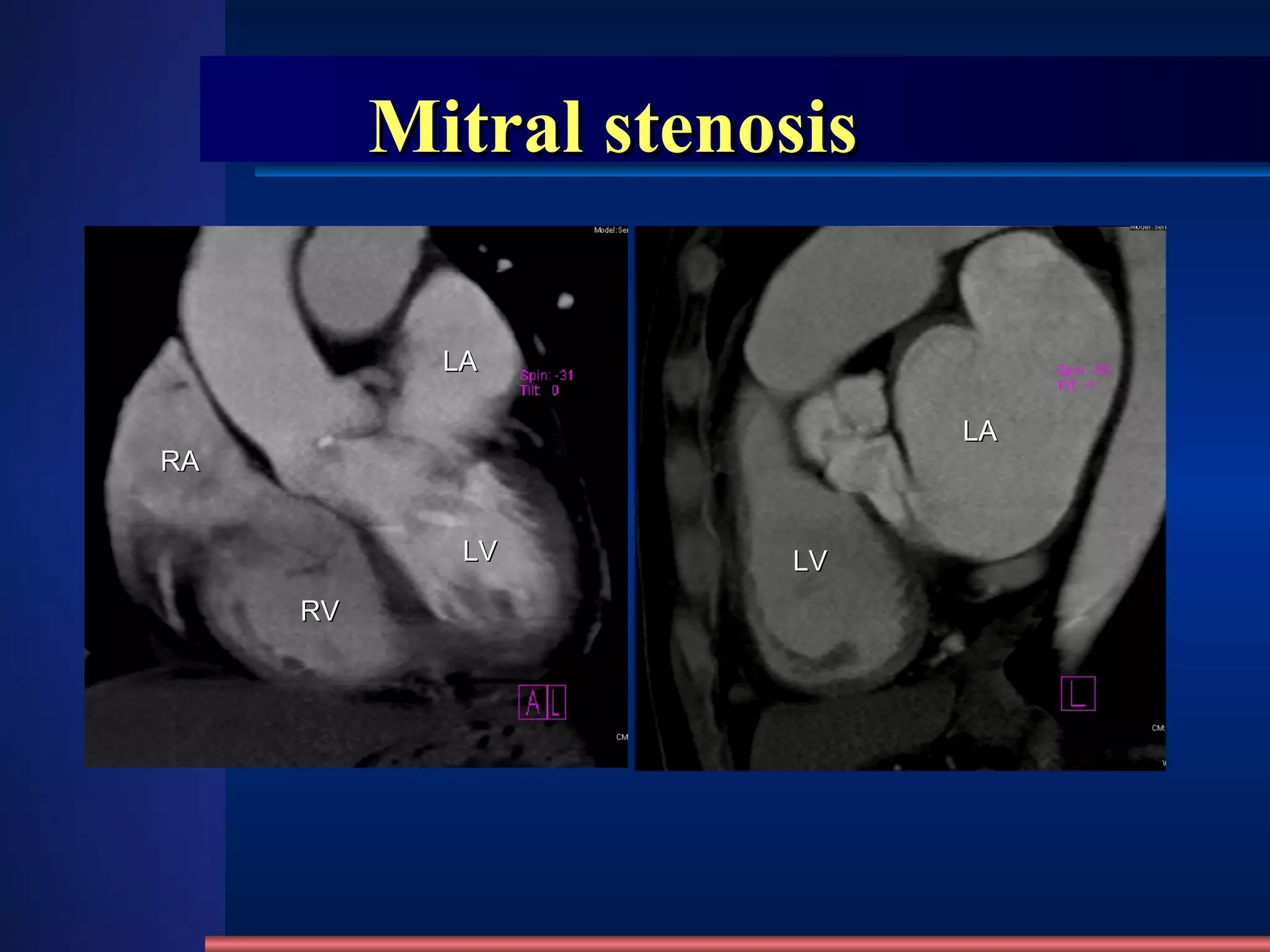Mitral stenosis LA LV LV LA RV RA 