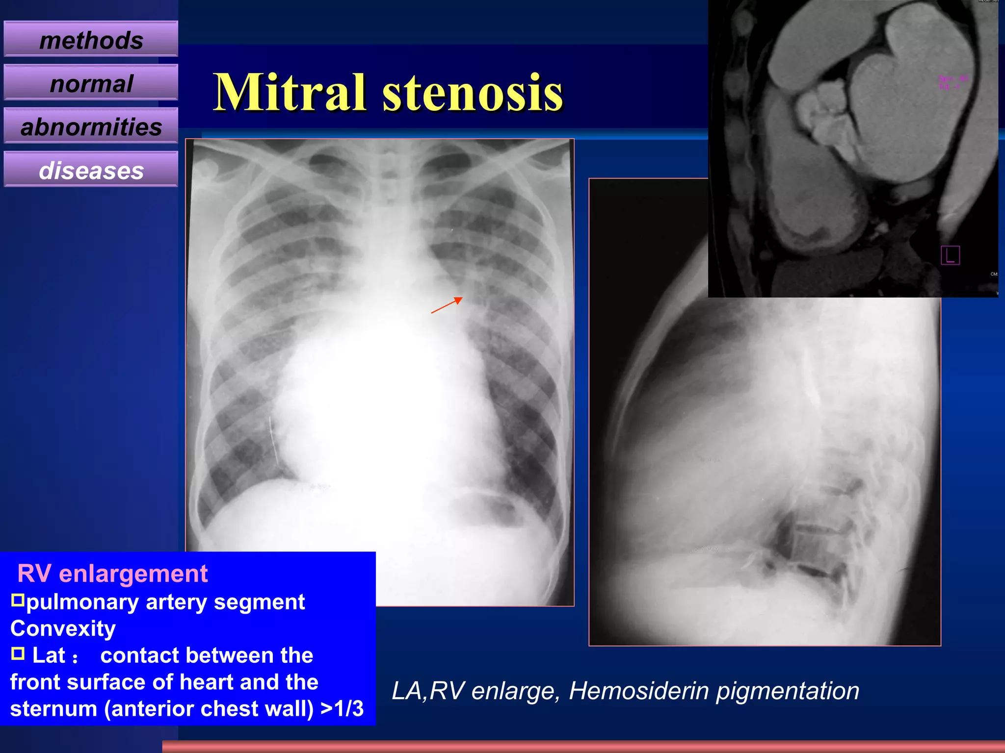 Mitral stenosis LA,RV enlarge, Hemosiderin pigmentation RV enlargement pulmonary artery segment Convexity Lat ： contact between the front surface of heart and the sternum (anterior chest wall) >1/3   methods normal abnormities diseases 