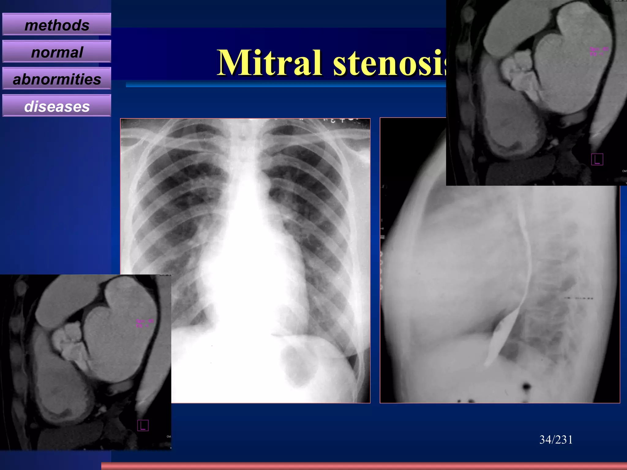 Mitral stenosis /231 methods normal abnormities diseases 