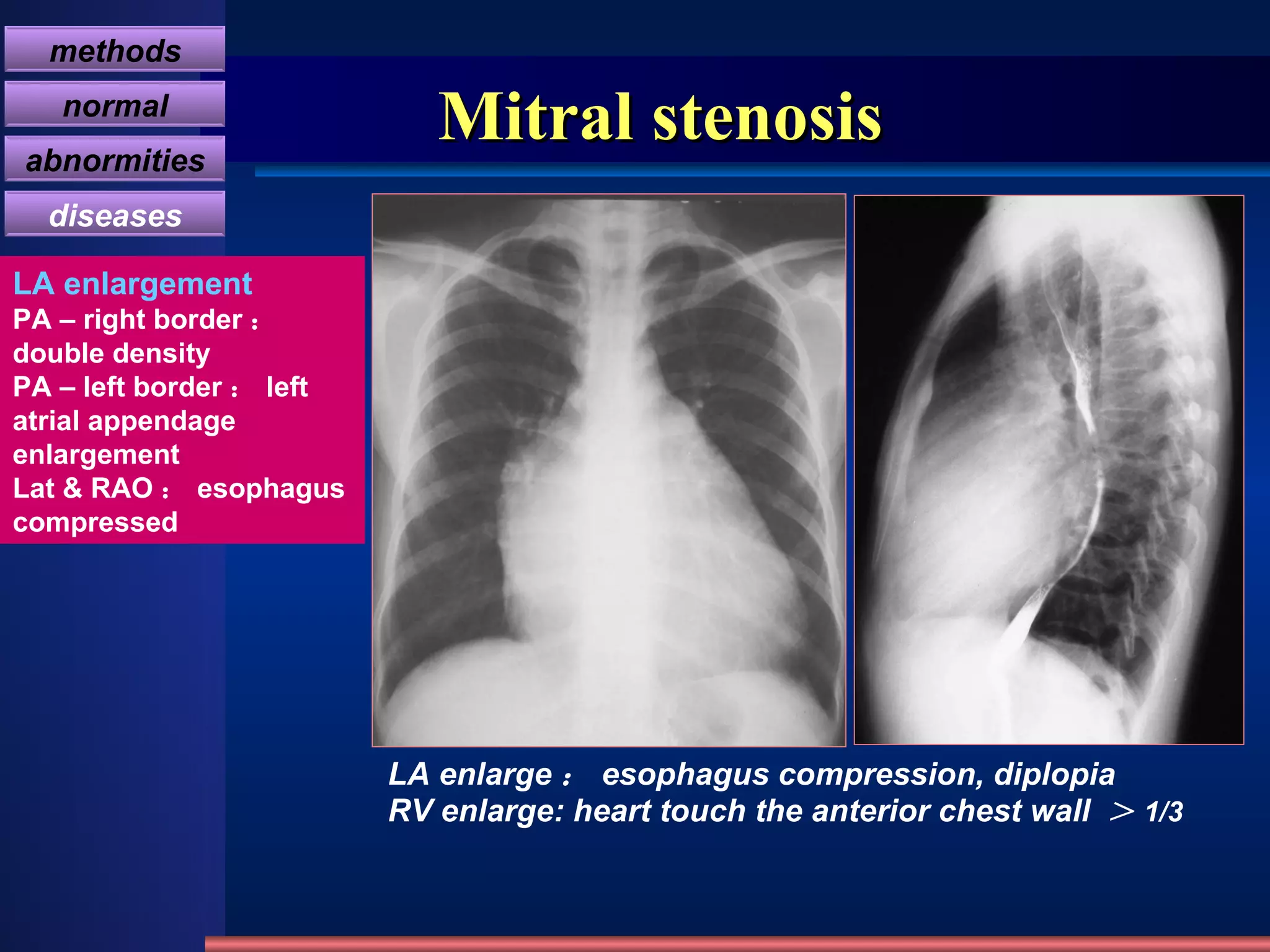 Mitral stenosis LA enlarge ： esophagus compression, diplopia RV enlarge: heart touch the anterior chest wall  ＞ 1/3 LA enlargement PA – right border ： double density PA – left border ： left atrial appendage enlargement Lat & RAO ： esophagus compressed methods normal abnormities diseases 