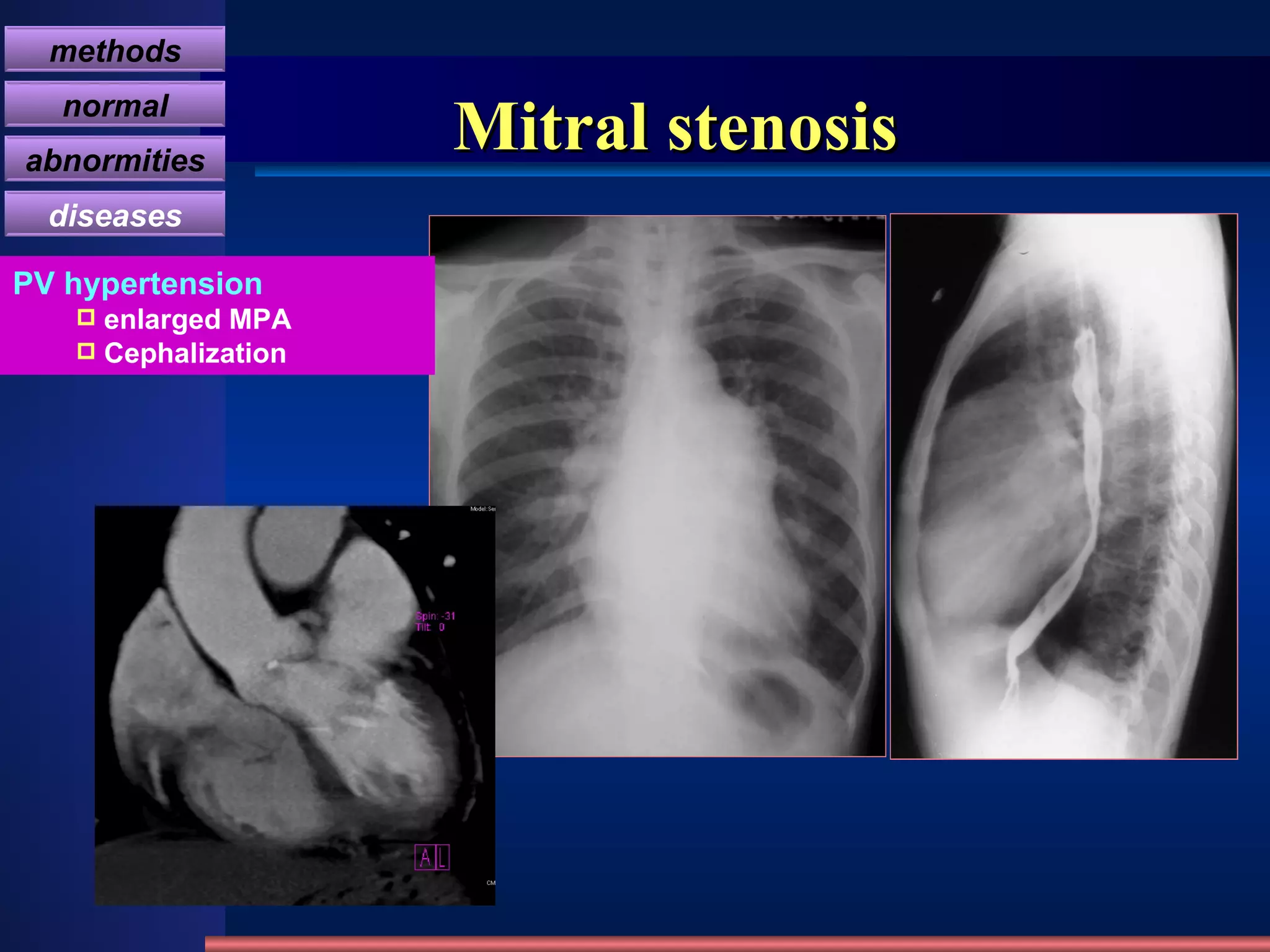 Mitral stenosis PV hypertension enlarged MPA Cephalization methods normal abnormities diseases 