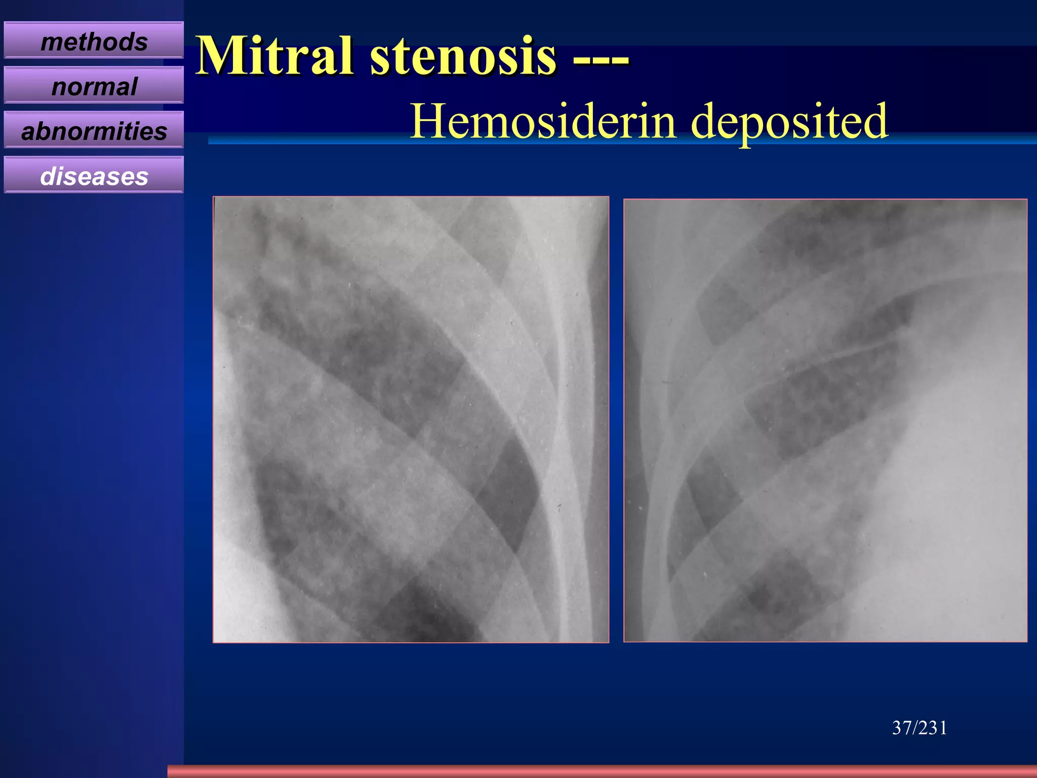 Mitral stenosis ---    Hemosiderin deposited /231 methods normal abnormities diseases 