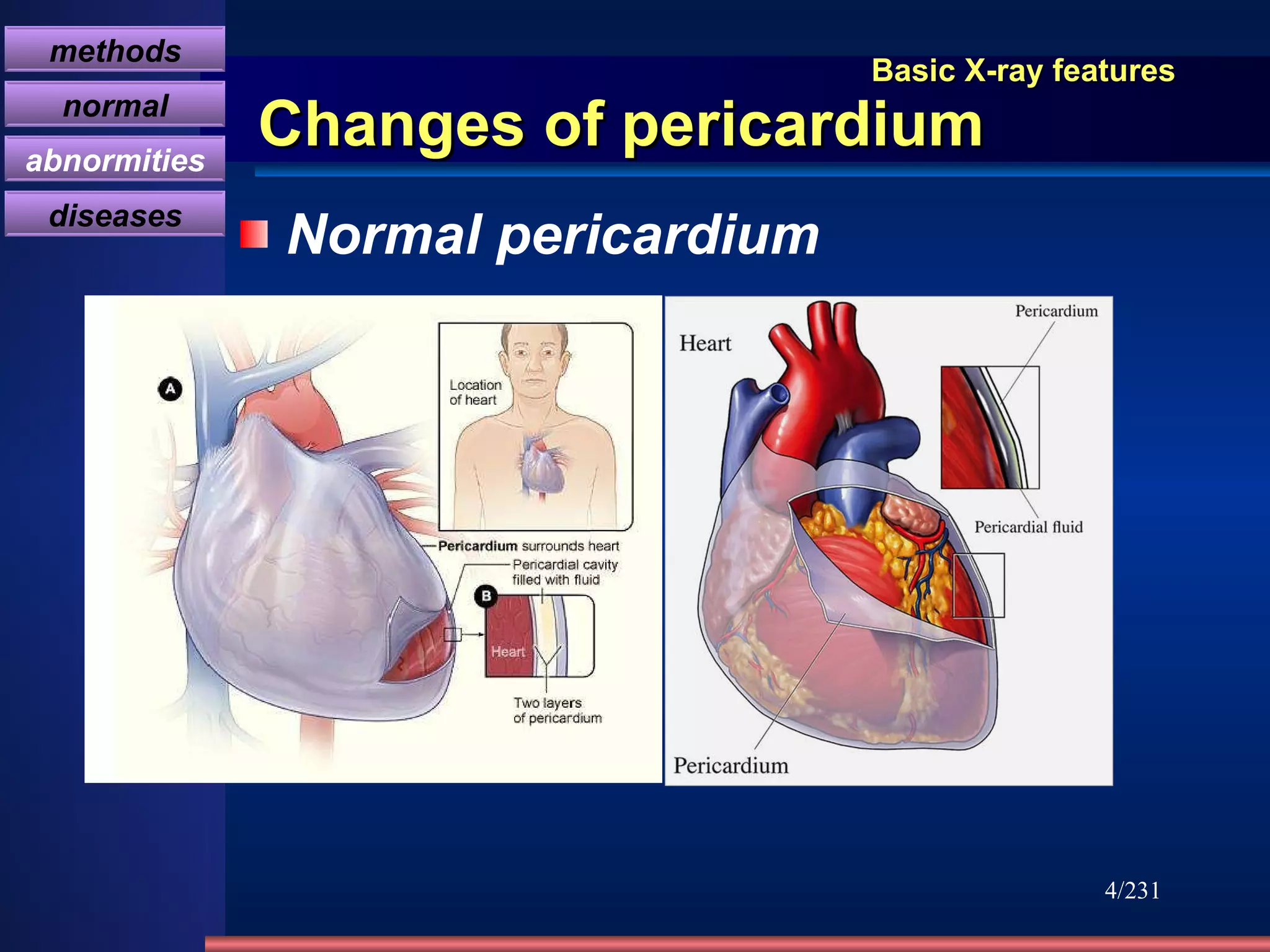 Basic X-ray features Changes of pericardium Normal pericardium /231 methods normal abnormities diseases 