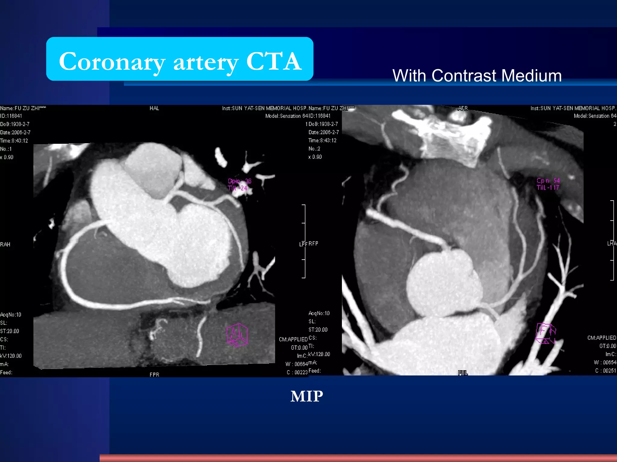 Coronary artery CTA MIP With Contrast Medium 