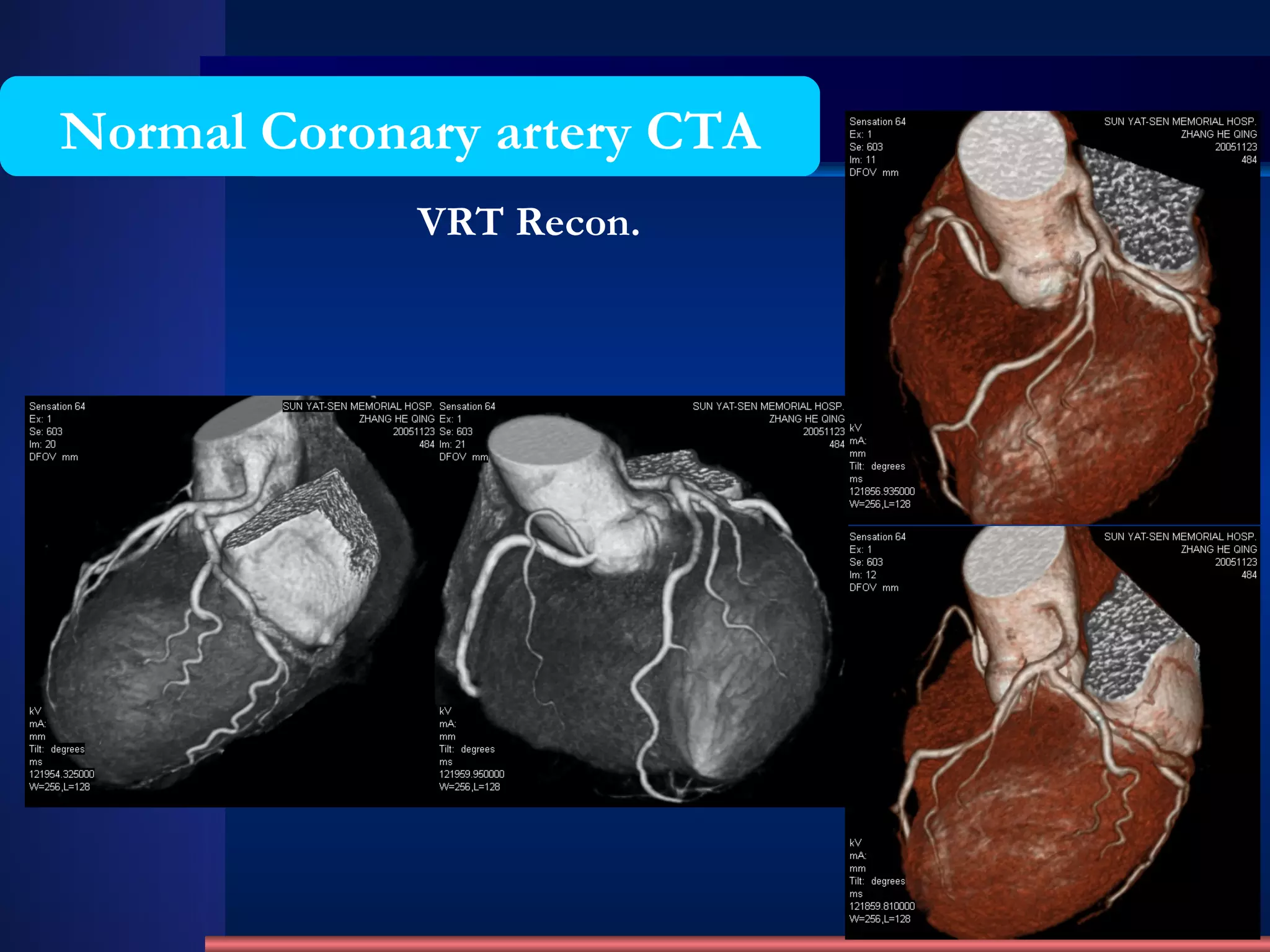 VRT Recon. Normal Coronary artery CTA 