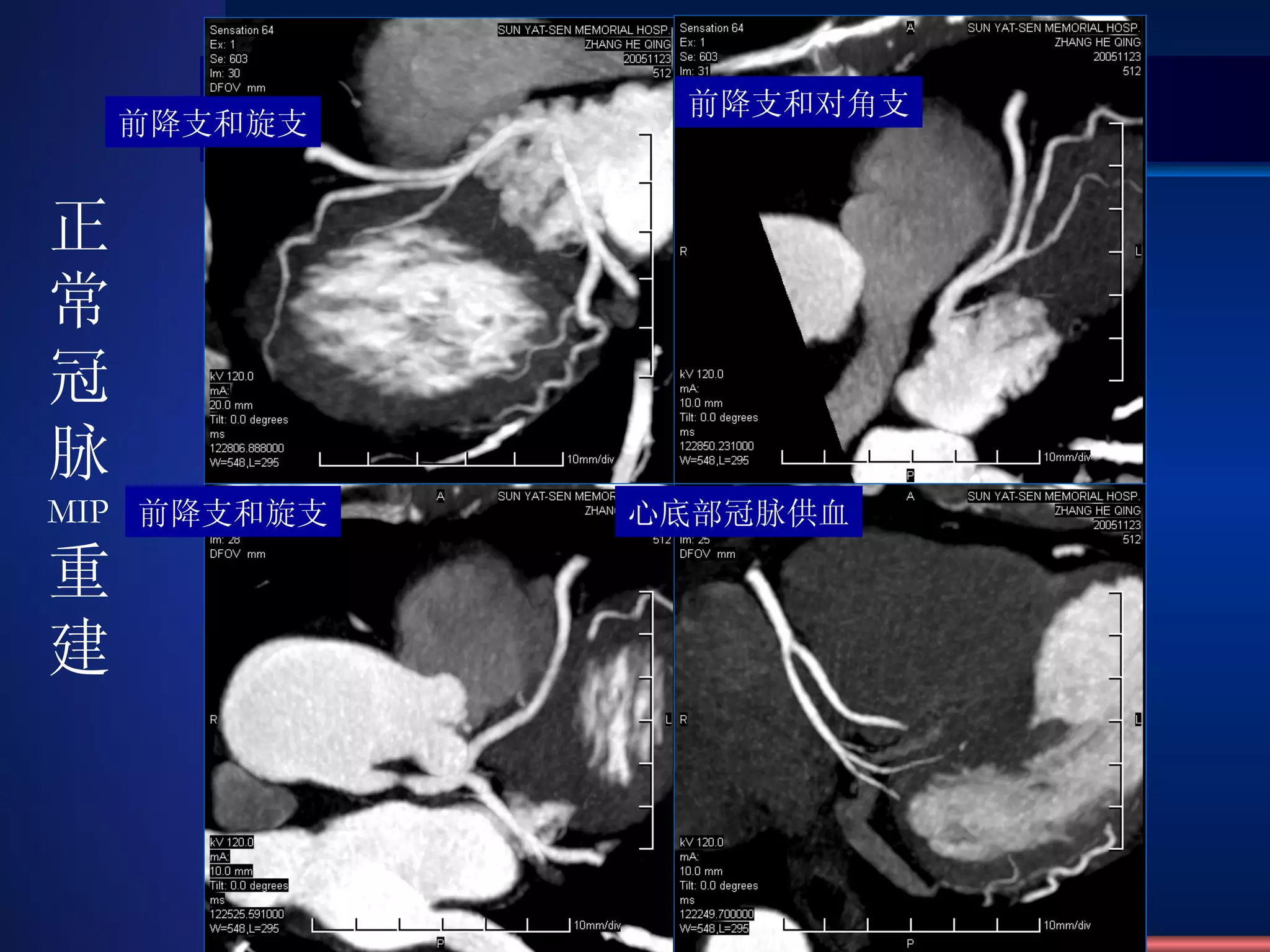 前降支和旋支 前降支和对角支 前降支和旋支 心底部冠脉供血 正常冠脉 MIP 重建 