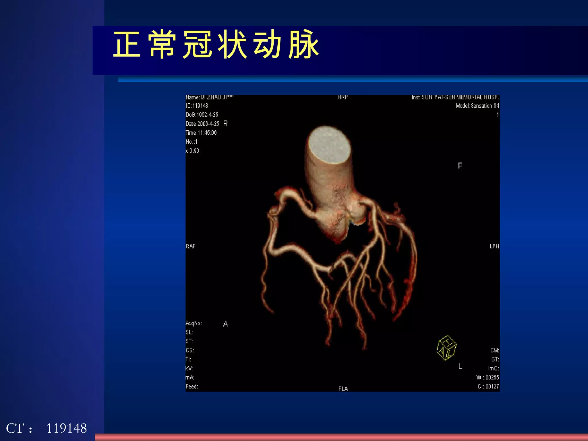 正常冠状动脉 CT ： 119148 