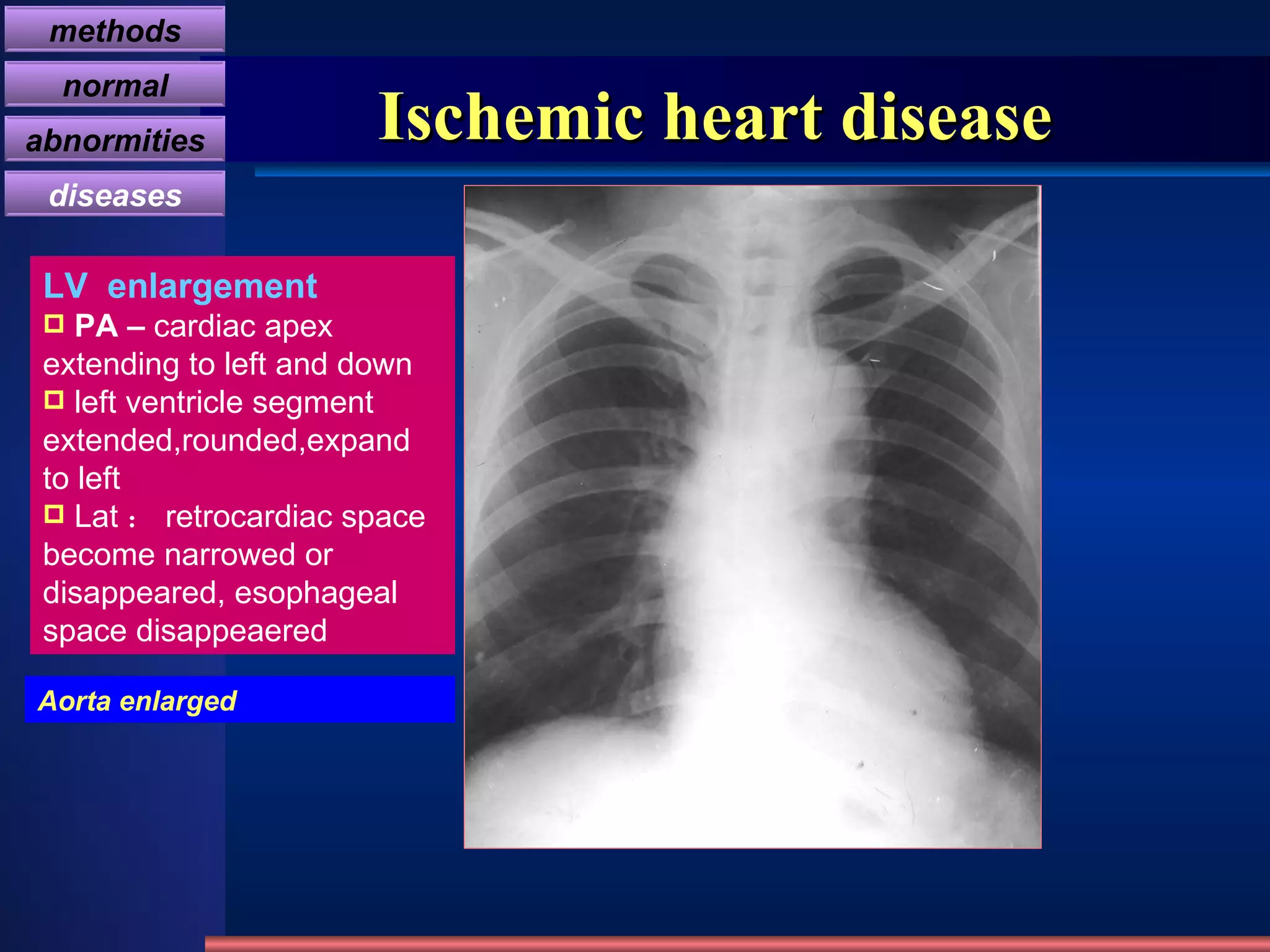 Ischemic heart disease LV  enlargement PA –  cardiac apex extending to left and down left ventricle segment extended,rounded,expand to left Lat ： retrocardiac space become narrowed or disappeared, esophageal space disappeaered  Aorta enlarged methods normal abnormities diseases 