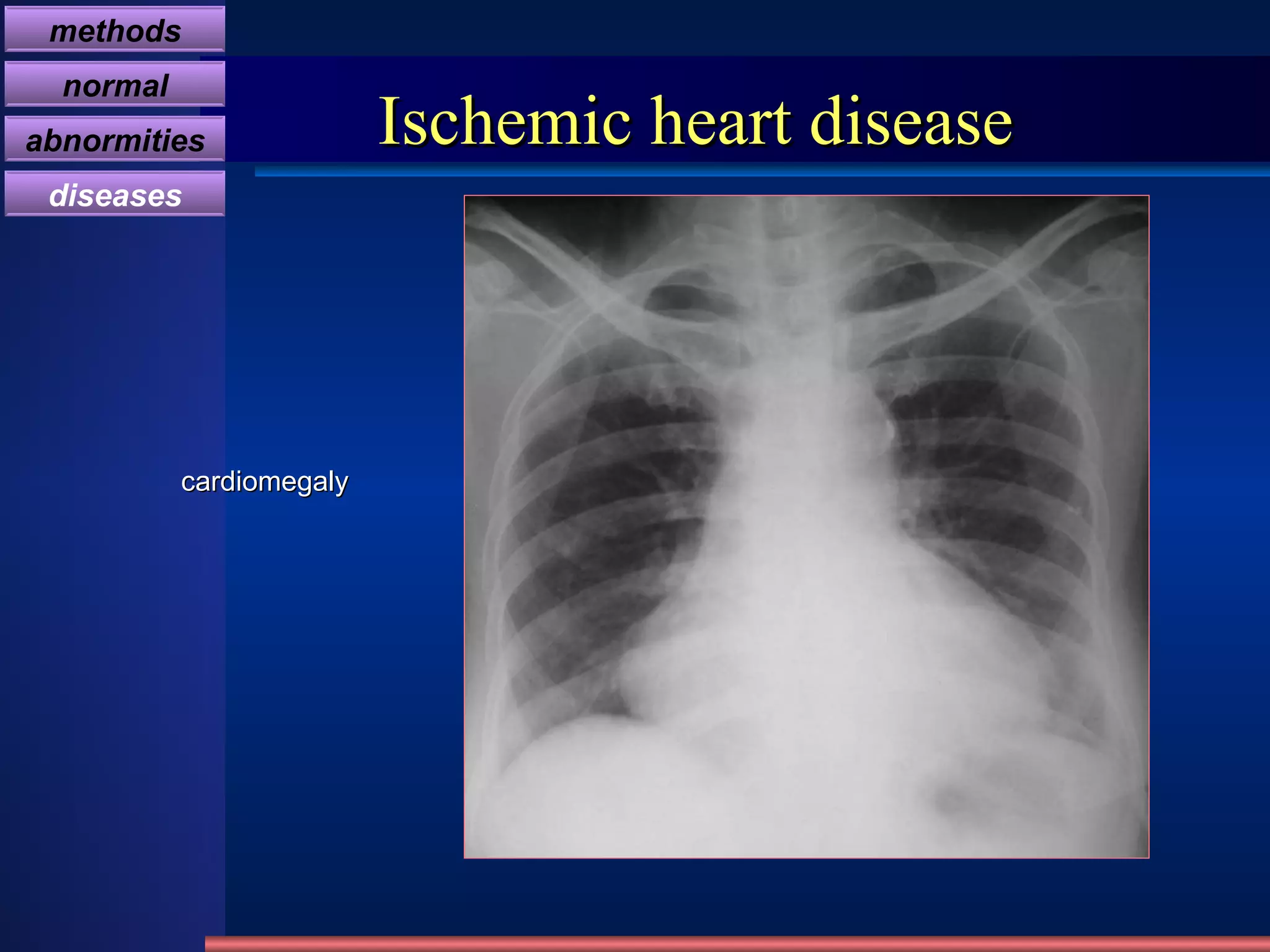 Ischemic heart disease cardiomegaly methods normal abnormities diseases 