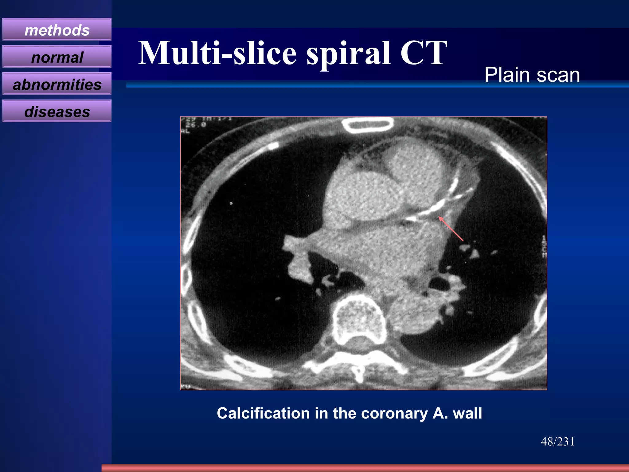 Multi-slice spiral CT /231 Plain scan Calcification in the coronary A. wall methods normal abnormities diseases 