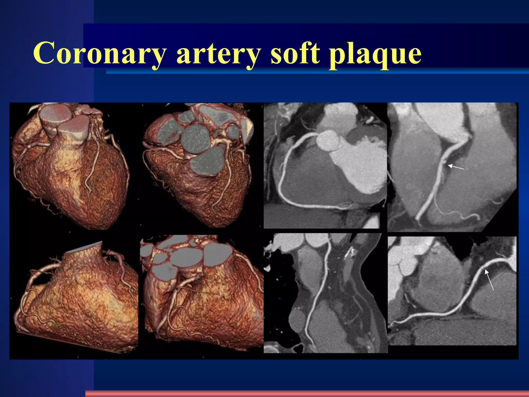 Coronary artery soft plaque 