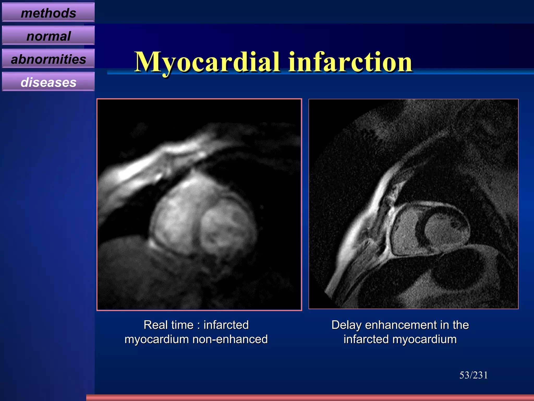 Myocardial infarction /231 Real time : infarcted myocardium non-enhanced Delay enhancement in the infarcted myocardium methods normal abnormities diseases 